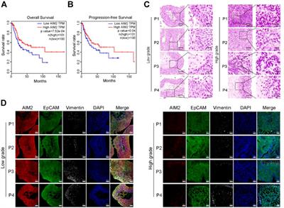 AIM2 inflammasome activation benefits the therapeutic effect of BCG in bladder carcinoma